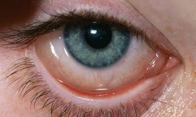 What is the cause of dry eye?