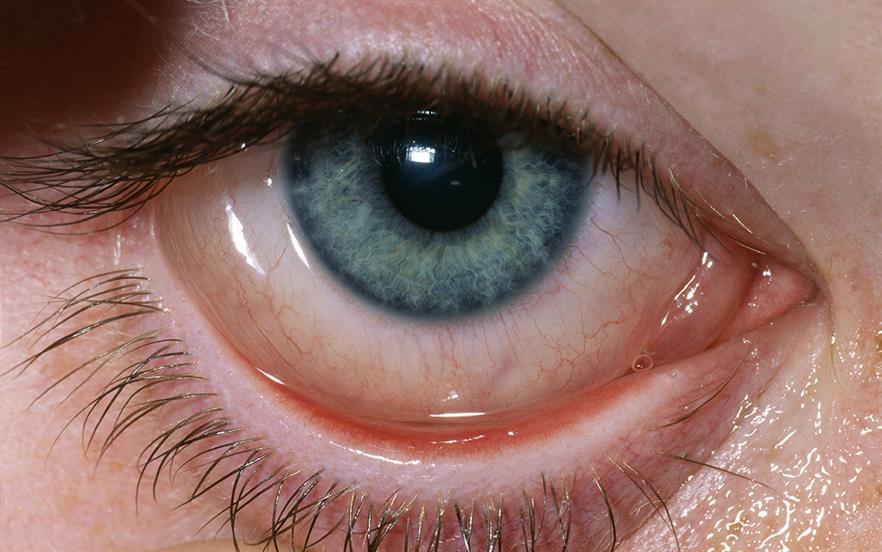 What is the cause of dry eye?